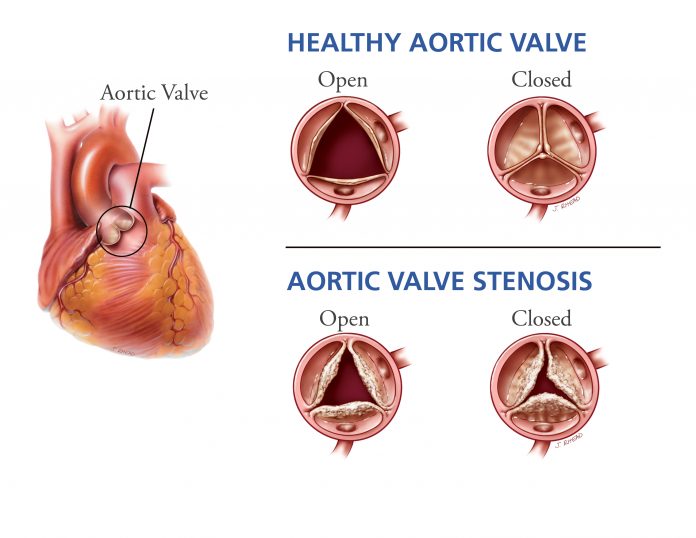 aortic valve stenosis 1