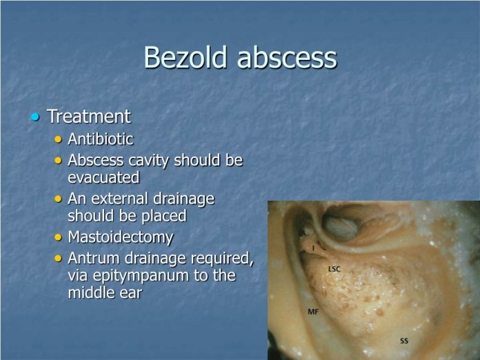 bezold abscess l