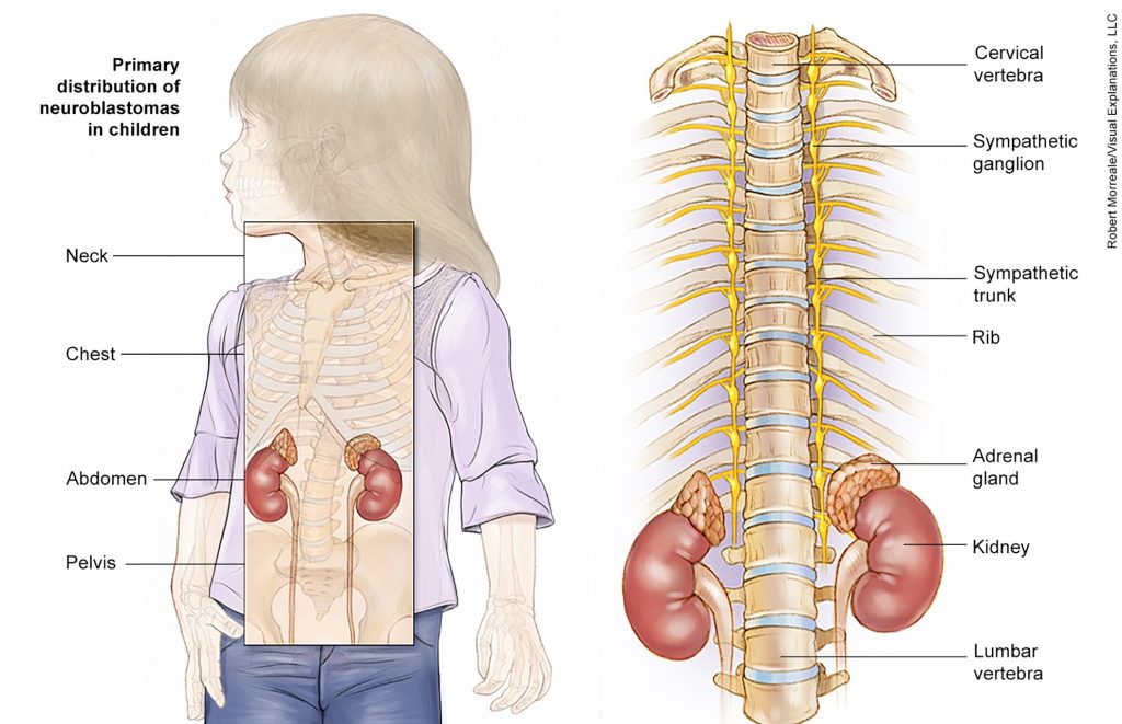 neuroblastoma print