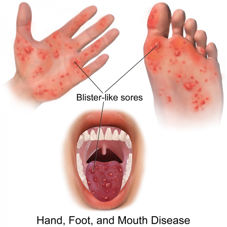 Νόσος χεριών, ποδιών και στόματος