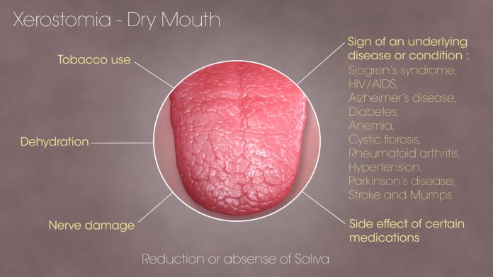 SAG Xerostomia Dry Mouth 160805 01