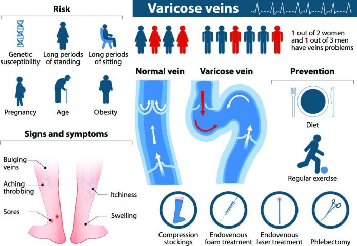 Varicose Vein Physiology