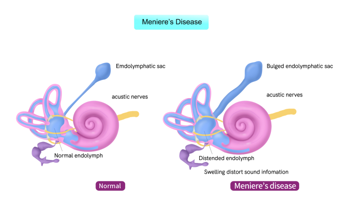 menieres disease in the ear