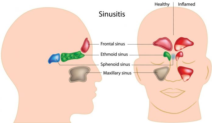 sinus infection 2 1024x596