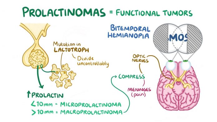 1920px Prolactinoma.webm