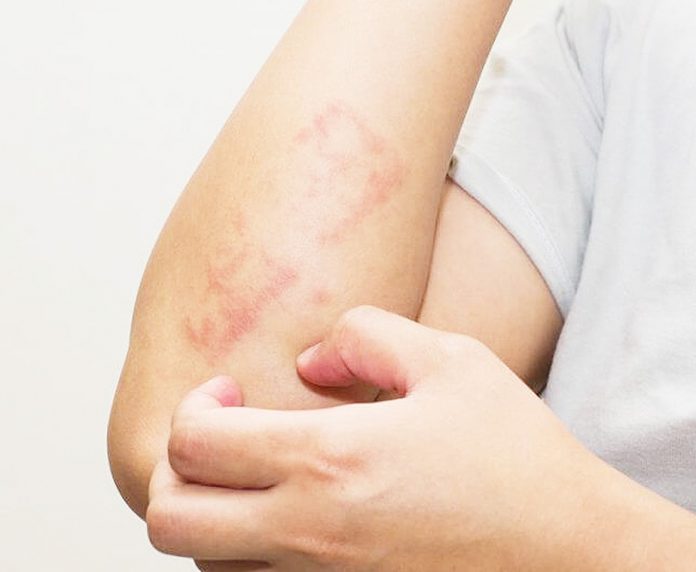 symtoms lichen sclerosus betterlifecarolinas