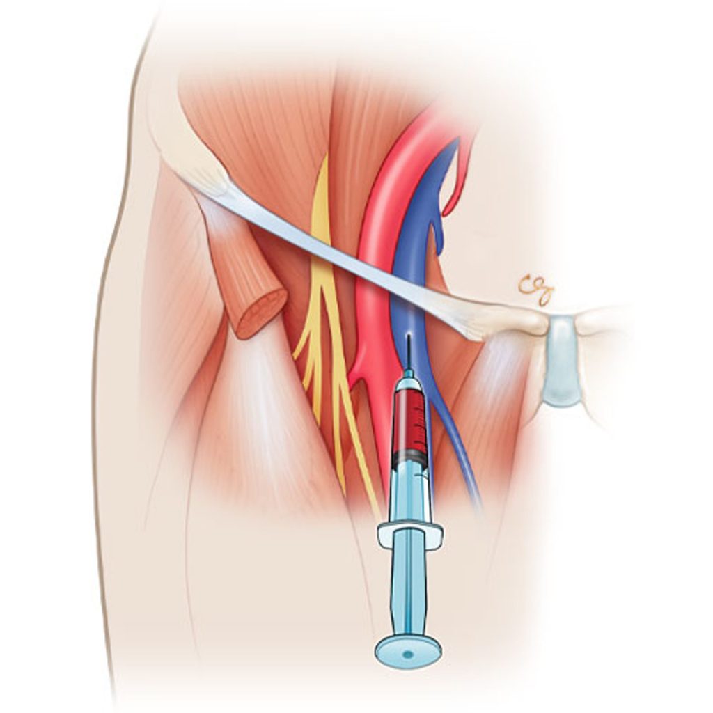 Αυτή η εικόνα δεν έχει ιδιότητα alt. Το όνομα του αρχείου είναι femoral-line-placement-1-1024x1024.jpg